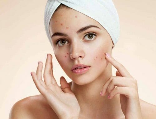 Sneaky Causes of Acne